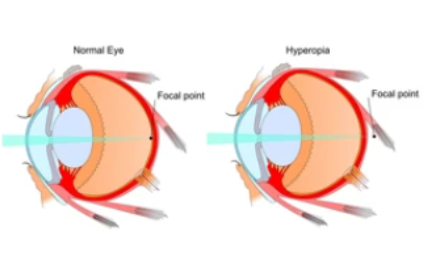 Hipermetropia Ce Este Cauze Si Tratament