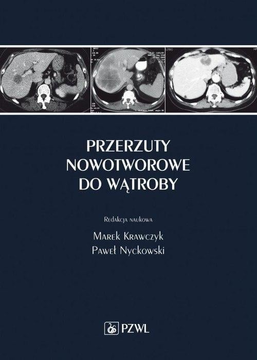 Przerzuty nowotworowe do wątroby