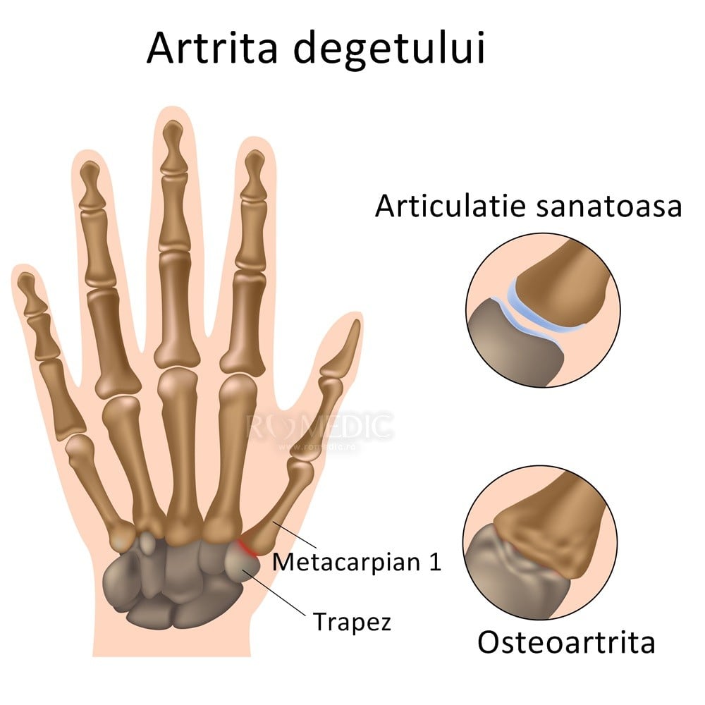 artrita medicatie articulara Pret deteriorarea sacului cotului