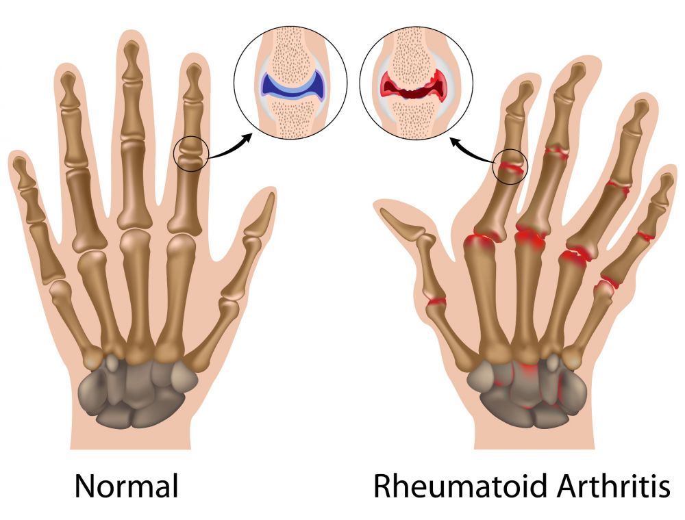 disfuncția articulației artritei reumatoide)