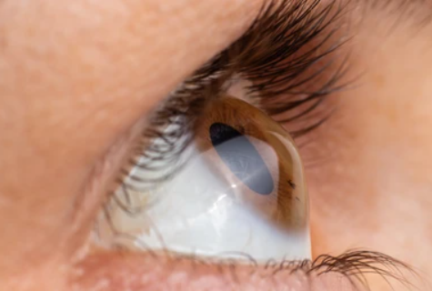 Ce este Cheratoconusul si cum ne afecteaza vederea?