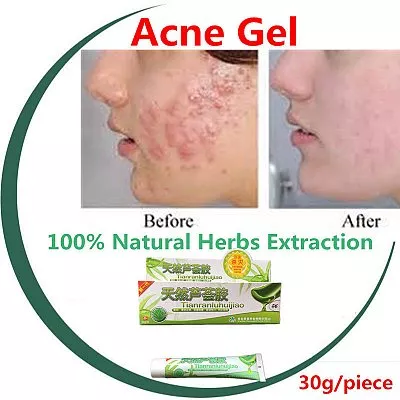 Despre acnee și gelul antiacneic cu Aloe vera