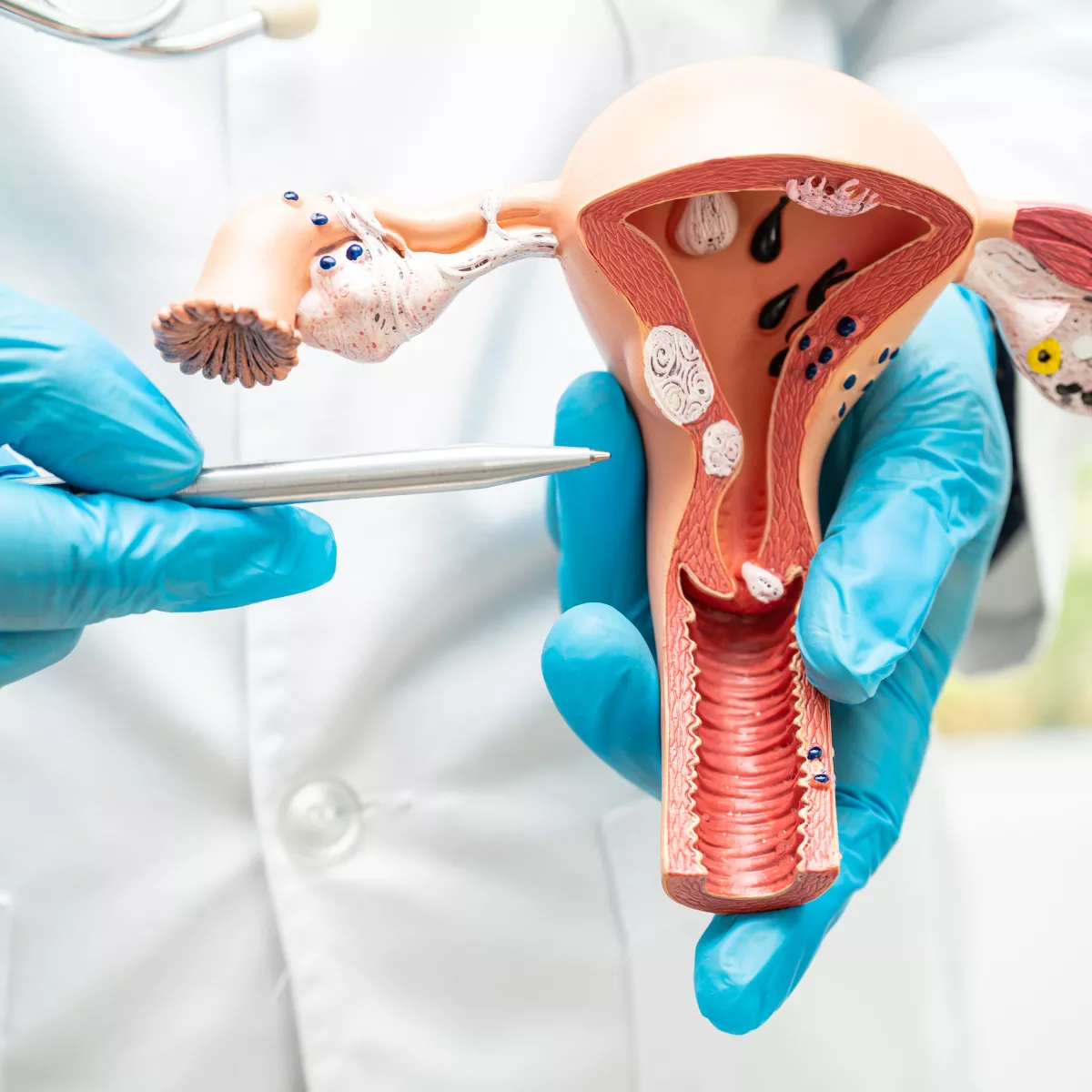 Endometrioza