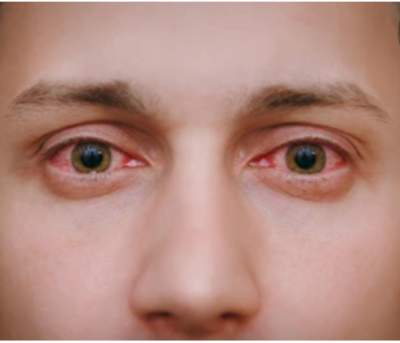 Ochii rosii : Cauze, simptome si tratament