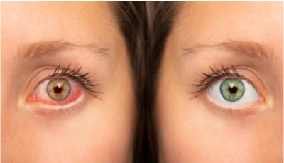 Sindromul de ochi uscat: cauze, simptome si tratament