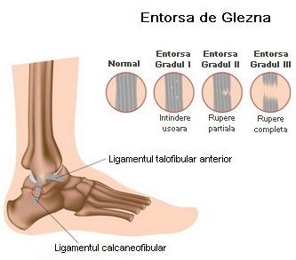 Entorsa perioadei de tratament a articulației genunchiului