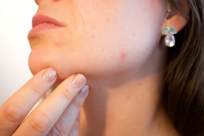 Despre acnee: cauze, prevenție și variante de tratament