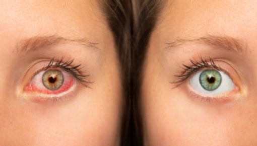 Melodramatic serviciu Izola  Sindromul de ochi uscat: cauze, simptome si tratament