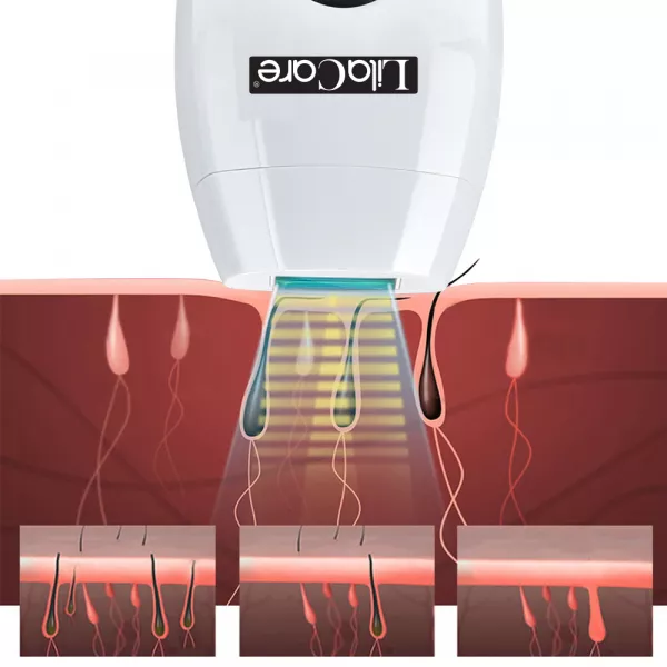 Epilator IPL Lila Care, epilare definitiva, 600.000 pulsatii, cu display LCD, 8 trepte de putere, Alb / Negru