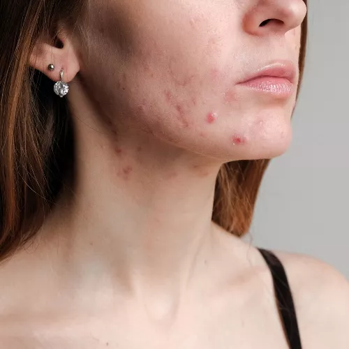 Cum scapam de semnele post acneice?